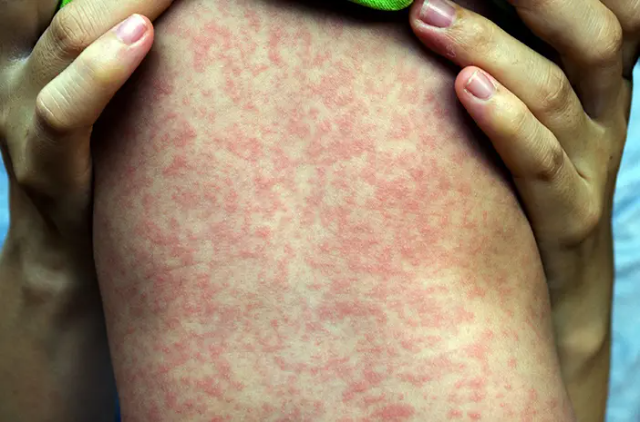 Tips Mengatasi Alergi Dingin Pada Remaja